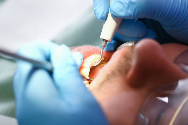 Best Emergency Dentist for Knocked-Out Tooth in Montgomery, TX